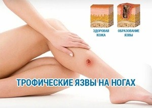  Трофические язвы на ногах: что это и как с ними бороться?