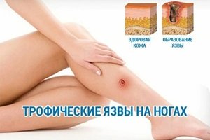 Трофические язвы на ногах: что это и как с ними бороться?